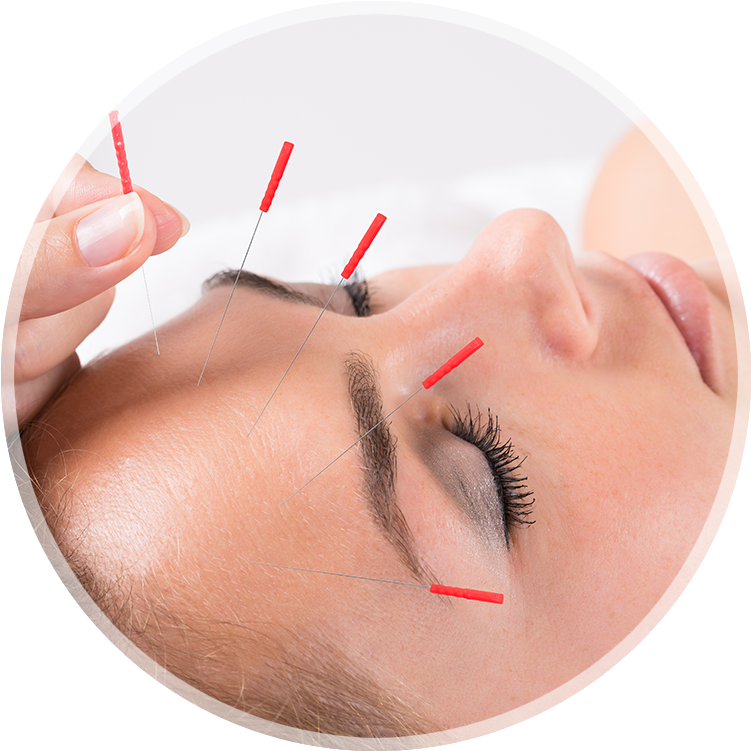 Acupuncture_ Therapy_for_ Headache