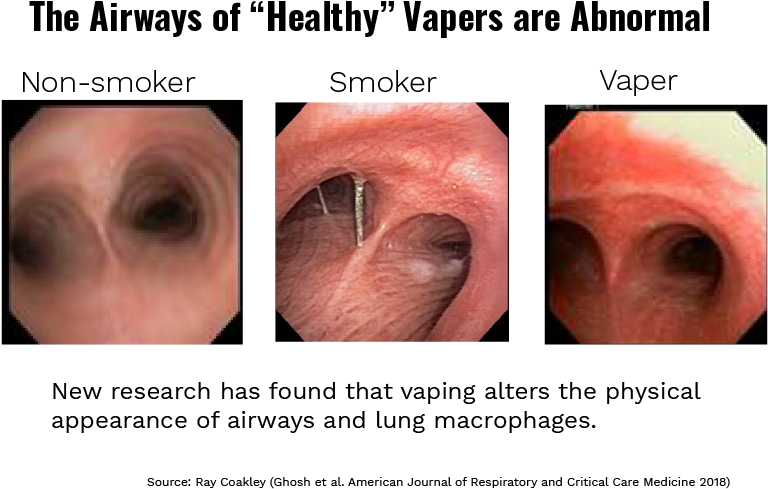 Airway Comparison Non Smoker Smoker Vaper