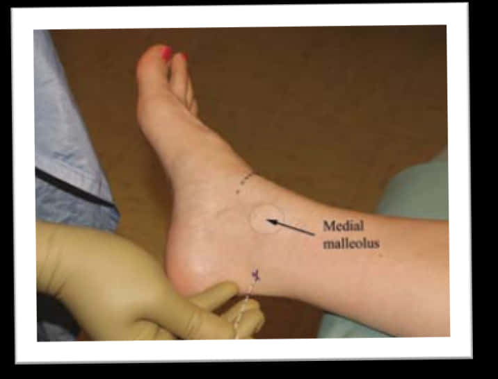 Ankle Injection Demonstration