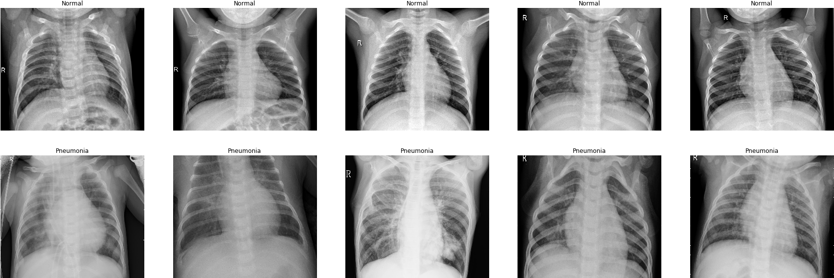 Chest Xray Comparison Normalvs Pneumonia