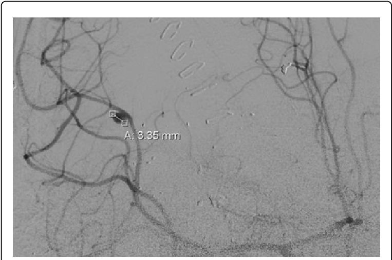 Coronary_ Angiogram_with_ Stent_ Placement