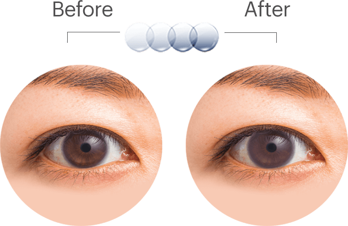 Eye Treatment Before After