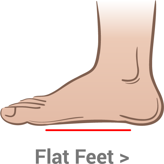 Flat Foot Condition Illustration