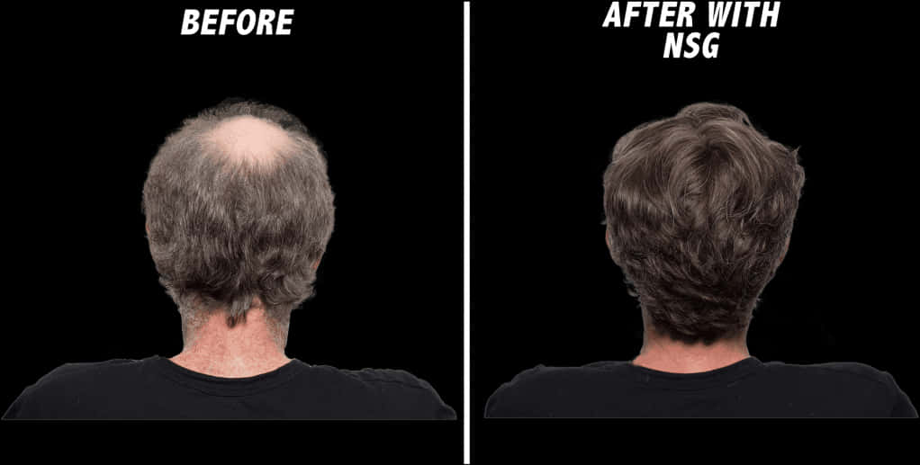 Hair Restoration Before After N S G