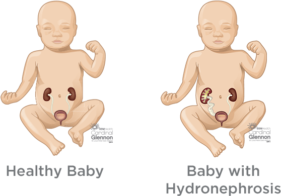 Healthyvs Hydronephrosis Baby Kidney Comparison