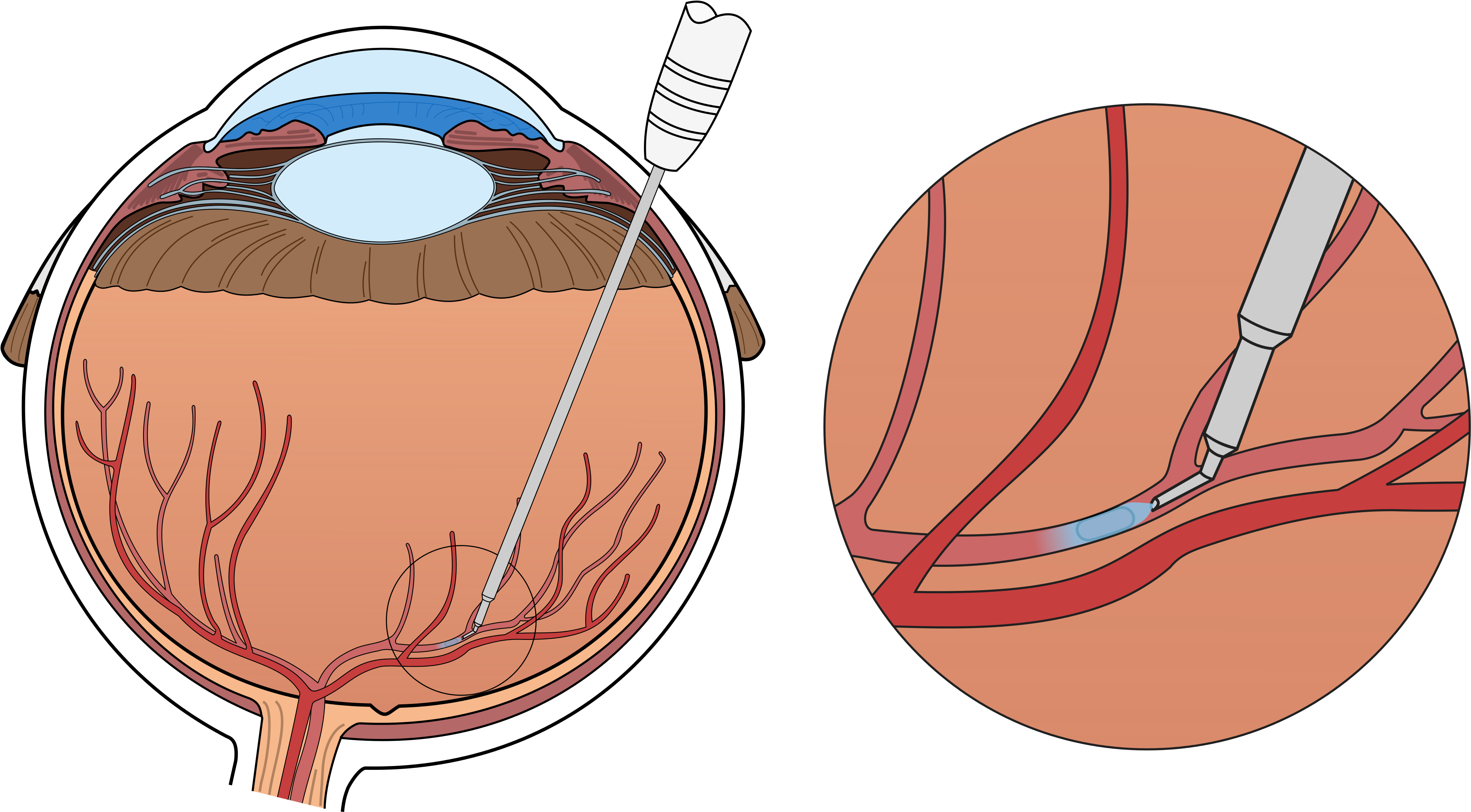 Intravitreal Injection Eye Treatment