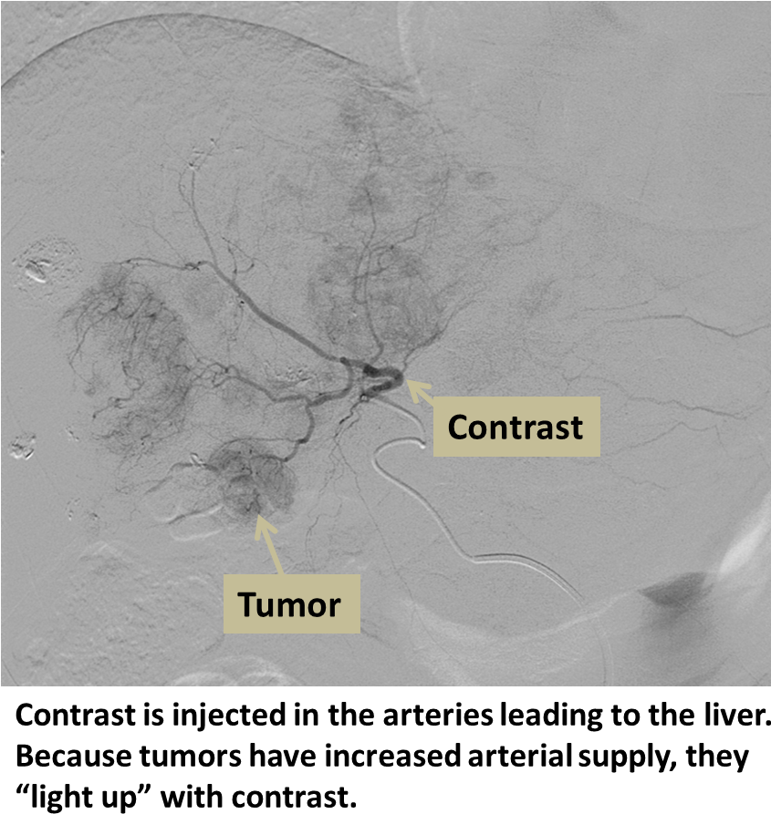 Liver Angiogram Tumor Detection | PNGpix.com