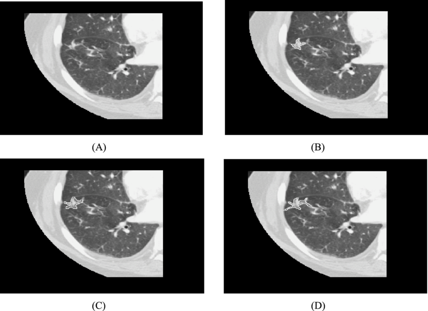 Lung C T Scan Quadrants