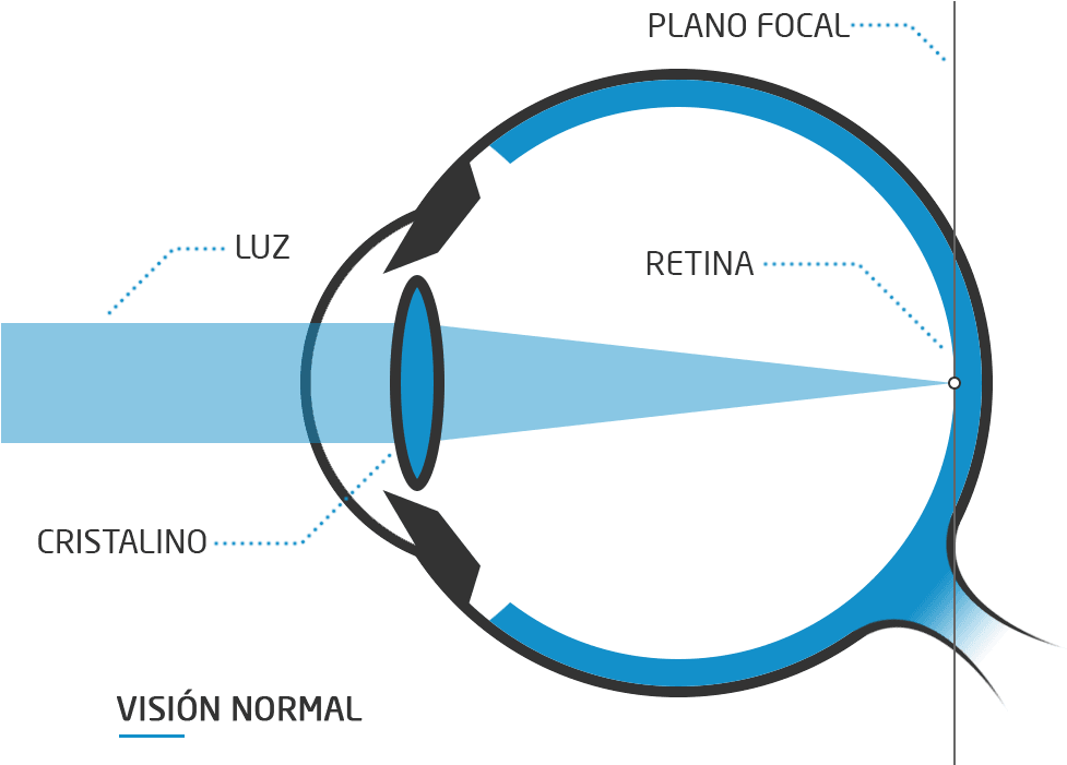 Normal Vision Light Refraction Diagram