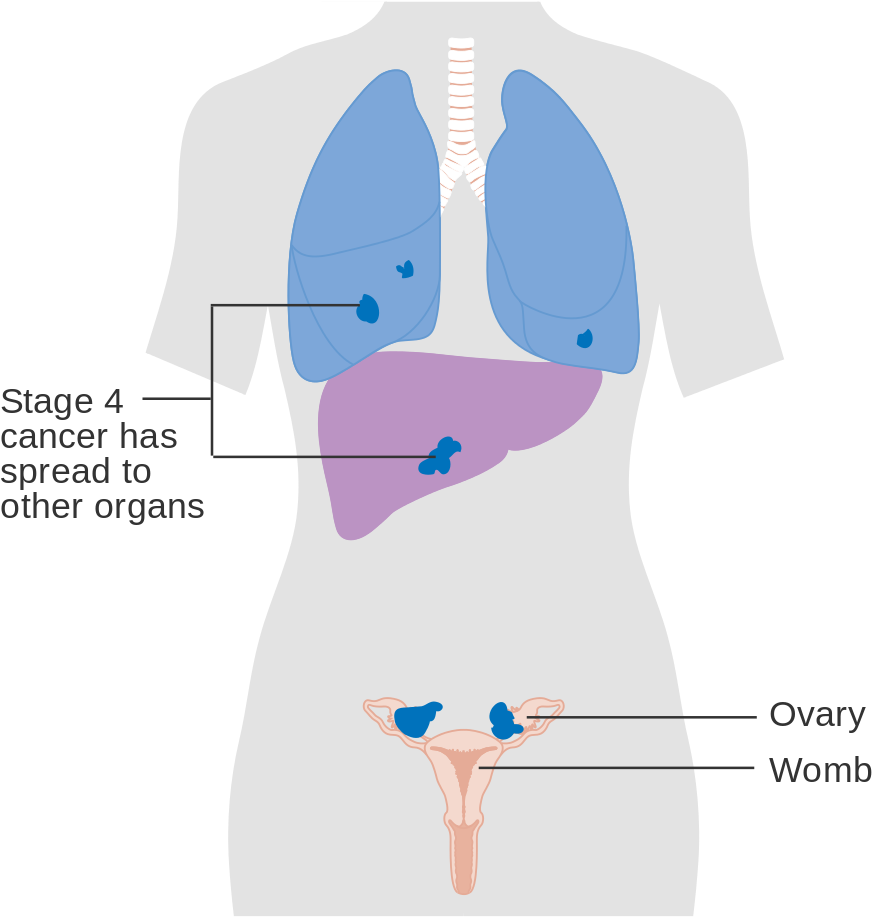 Stage4 Cancer Spread Illustration