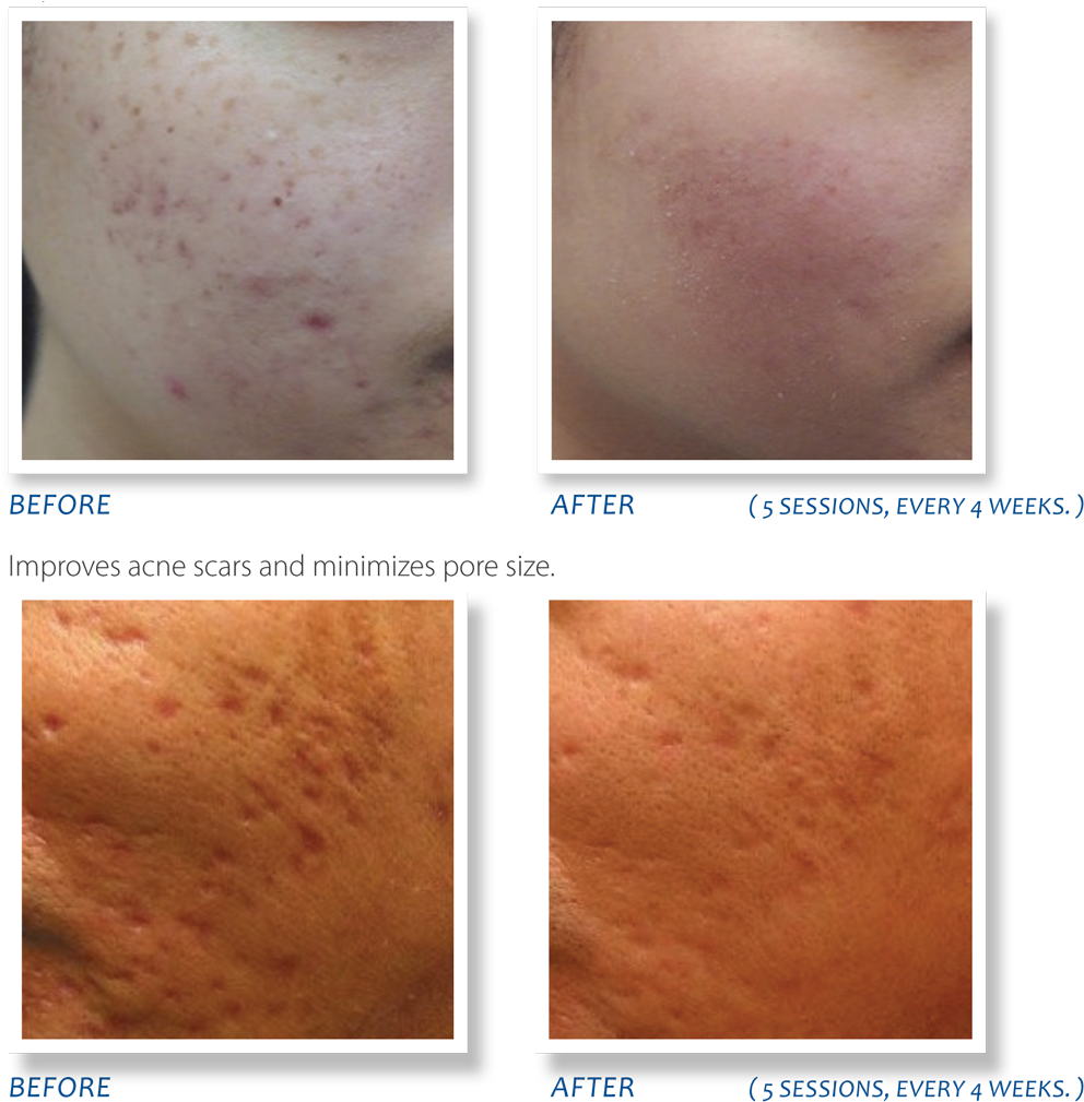 Acne Scar Treatment Before After Comparison PNG image
