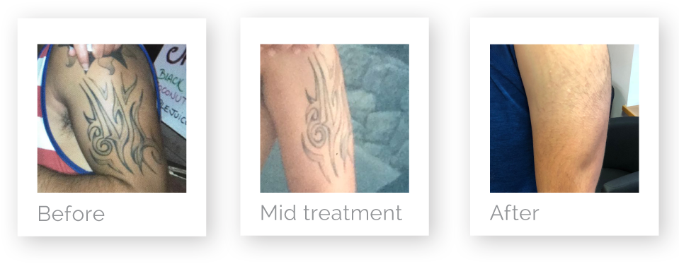 Arm Tattoo Removal Progression PNG image