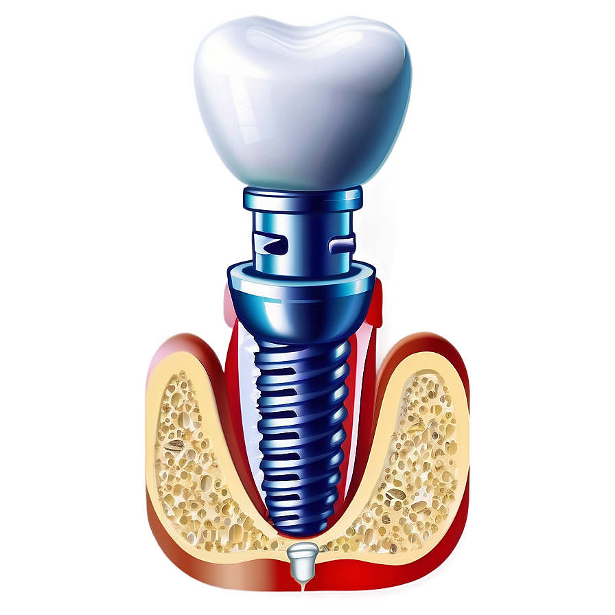 Dental Implants Diagram Png Cpe85 PNG image