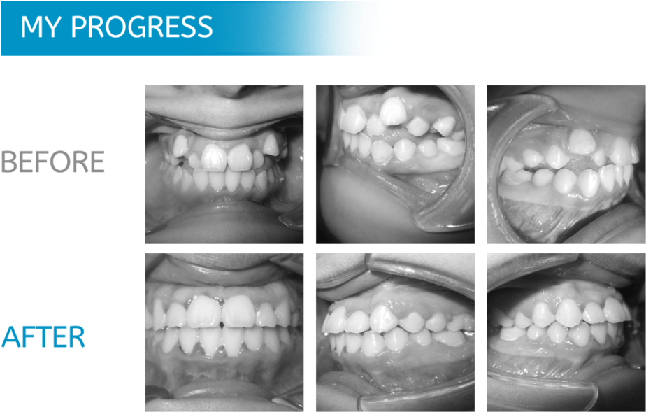 Dental Progress Before After PNG image