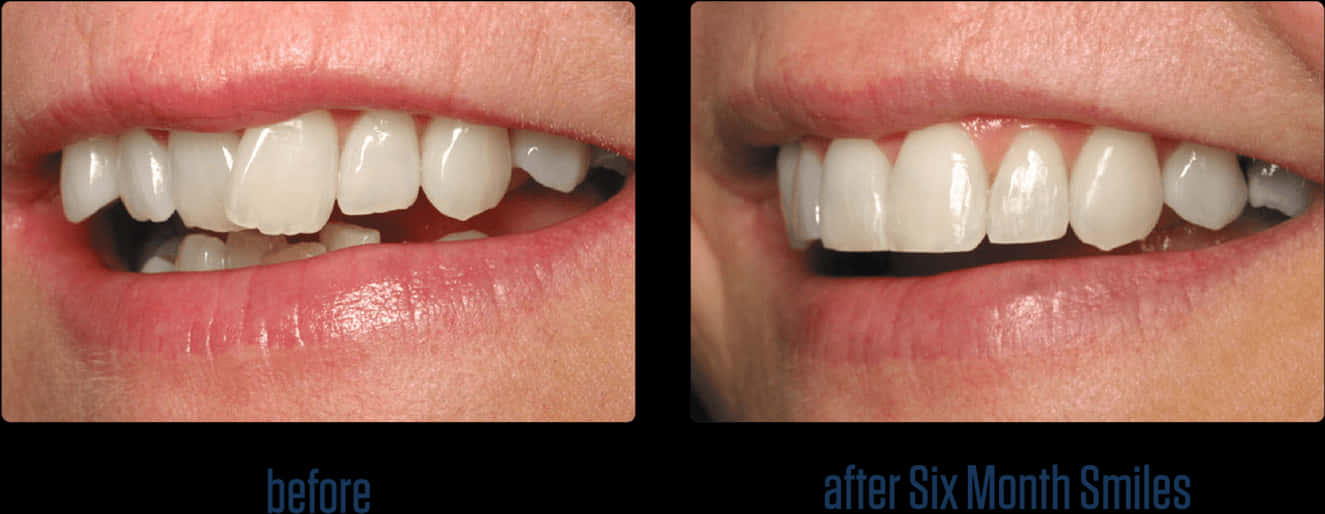 Dental_ Transformation_ Before_ After PNG image