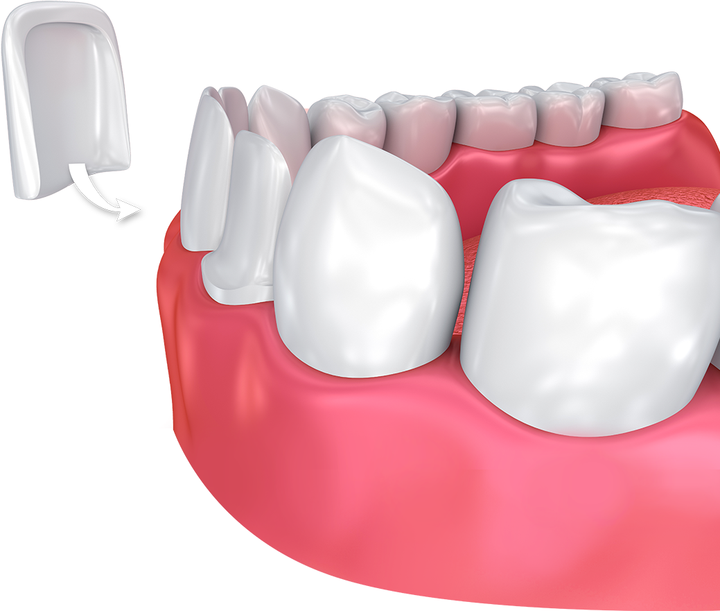 Dental Veneer Placement3 D Illustration PNG image
