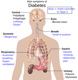 Diabetic Ketoacidosis Symptoms Infographic PNG image