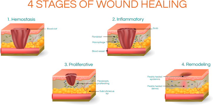 Four Stagesof Wound Healing Graphic PNG image