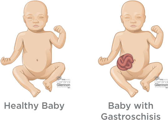 Healthyvs Gastroschisis Baby Comparison PNG image