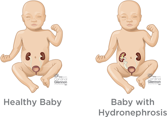 Healthyvs Hydronephrosis Baby Kidney Comparison PNG image