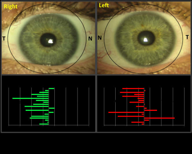 Human Eye Comparison Corneal Topography PNG image