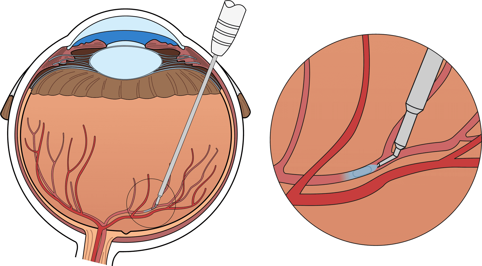 Intravitreal Injection Eye Treatment PNG image