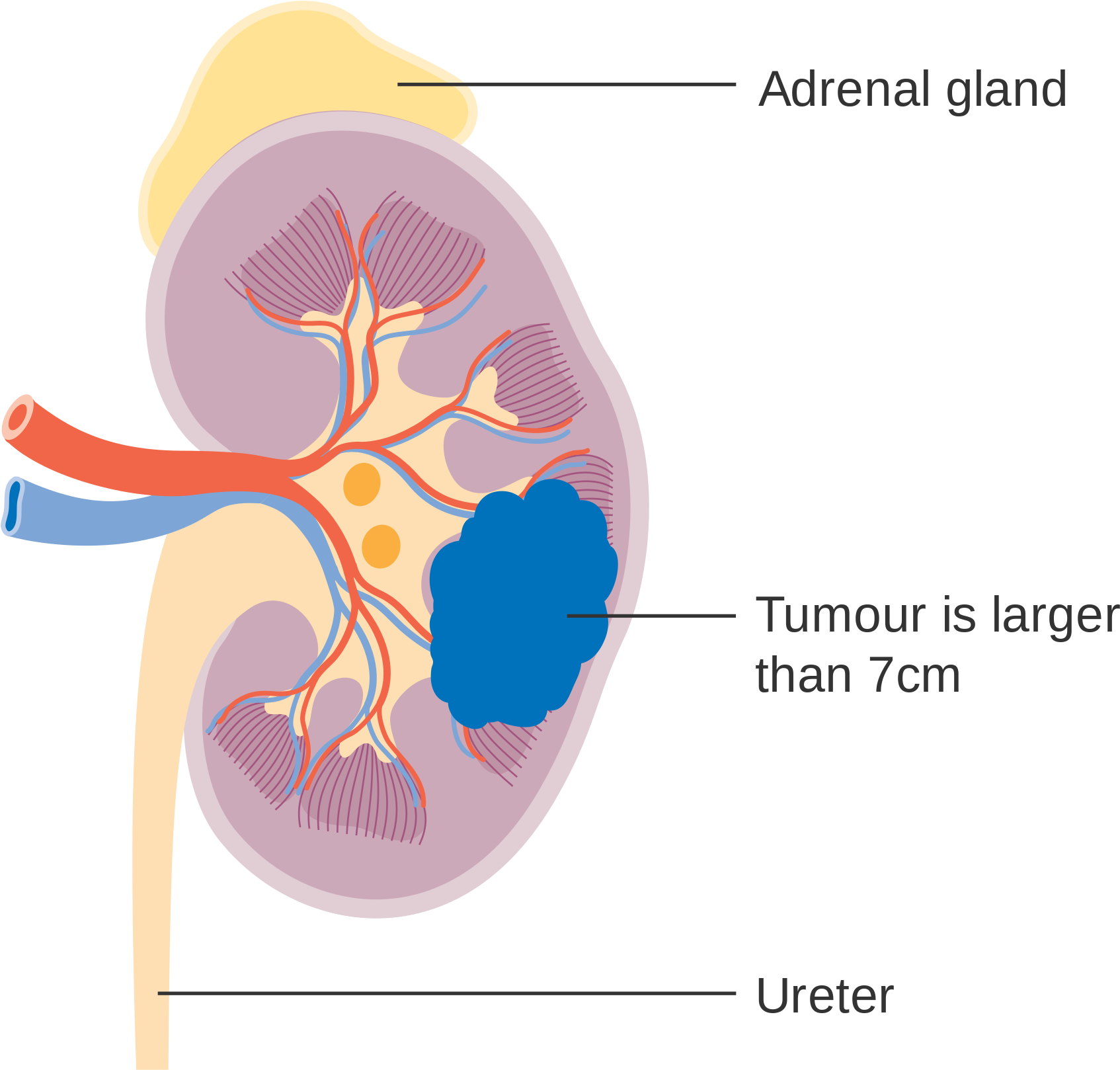 Kidney Anatomywith Tumor Illustration PNG image