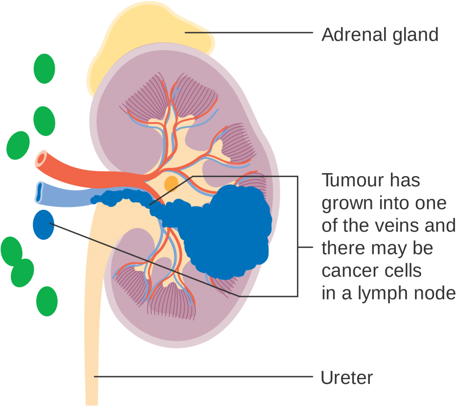 Kidney Cancer Diagram PNG image