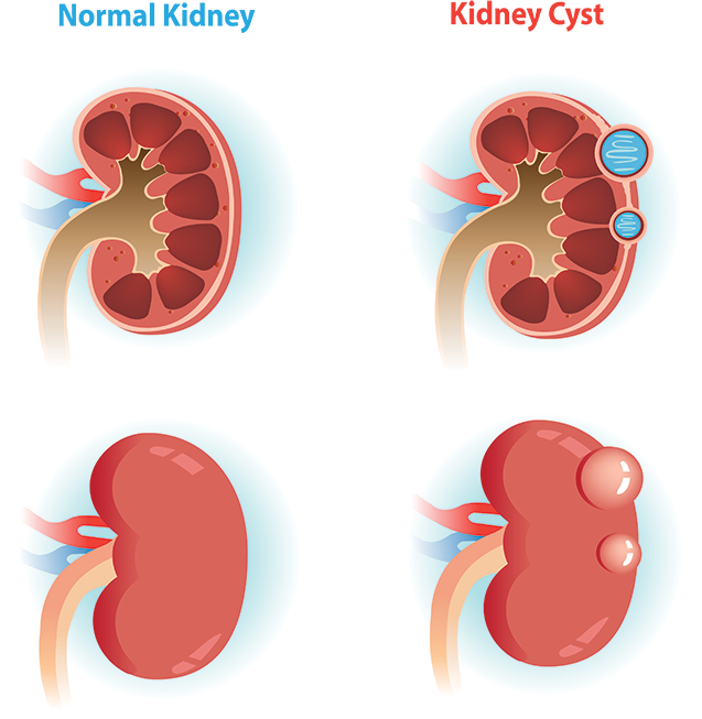 Kidney Health Comparison Illustration PNG image