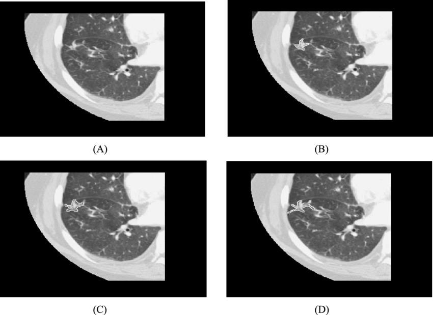 Lung C T Scan Quadrants PNG image