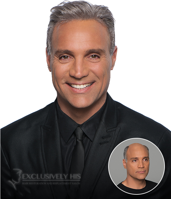 Mature Man Hair Restoration Transformation PNG image