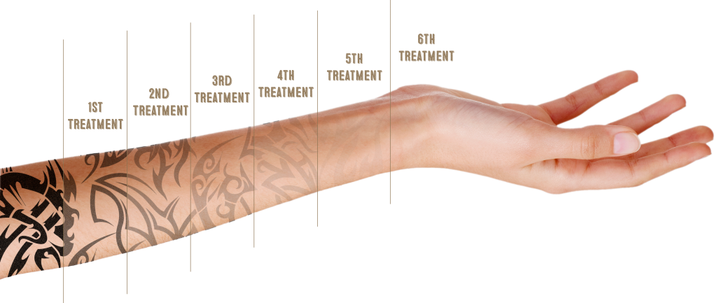Tattoo Removal Progression Arm PNG image