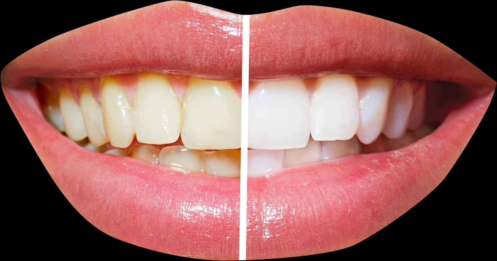 Teeth Whitening Comparison Smile.jpg PNG image