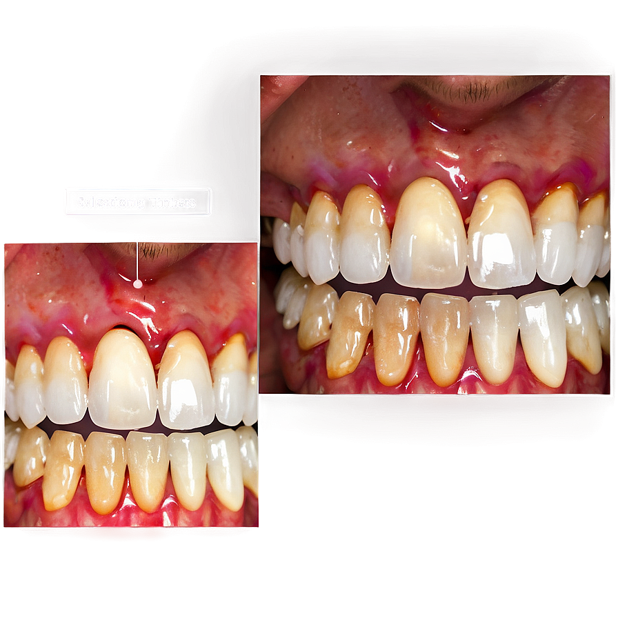 Teeth Whitening Procedure Png Bgo PNG image