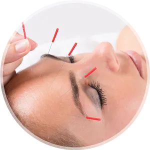 Acupuncture_ Therapy_for_ Headache PNG image