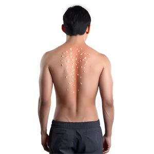 Back Acne Treatment Solutions Png 06252024 PNG image