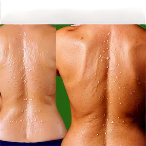 Back Acne Treatment Solutions Png 71 PNG image