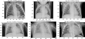 Chest_ Xray_ Comparison_ Normal_vs_ Pneumonia PNG image