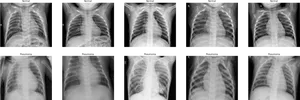 Chest Xray Comparison Normalvs Pneumonia PNG image