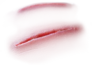 Close Up Healing Scar PNG image