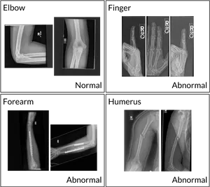 Comparative Xray Images Upper Limb PNG image