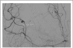 Coronary_ Angiogram_with_ Stent_ Placement PNG image