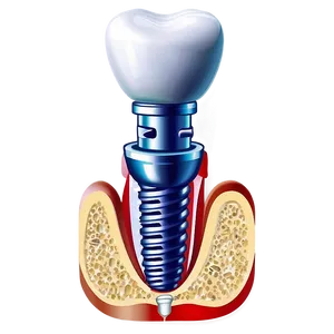 Dental Implants Diagram PNG Cpe85 PNG