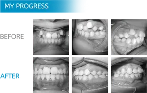 Dental Progress Before After PNG image