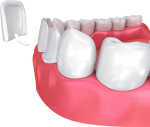Dental Veneer Placement3 D Illustration PNG image