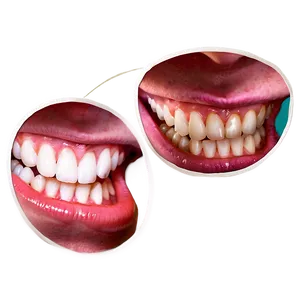 Dental Veneers Preview Png Fas31 PNG image