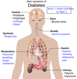 Diabetic Ketoacidosis Symptoms Infographic