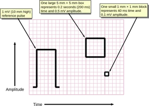 E C G Graph Paper Scale Explanation PNG