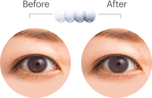 Eye Treatment Before After PNG image