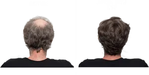 Hair Restoration Before After N S G